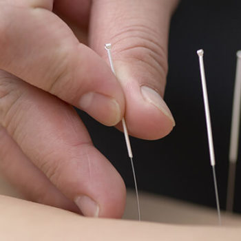 Acupuncture in Westfield, NJ